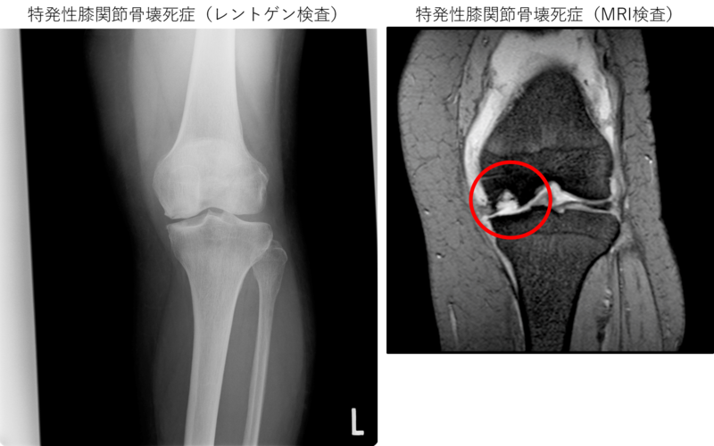 特発性膝関節骨壊死　MRI検査では骨の陥没が確認できる（右）