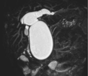 先天性胆道拡張症のMRCP像