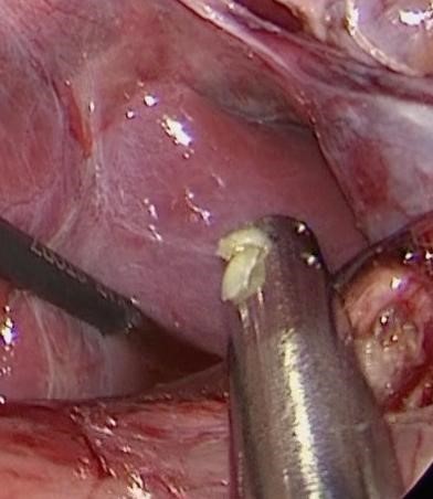腹腔内の金属の先にみられる白い2つの物質がタンパク栓