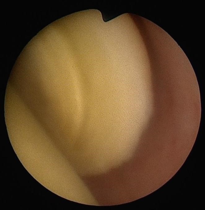 胆管や膵管を閉塞させる原因となる胆管内のタンパク栓（1）
