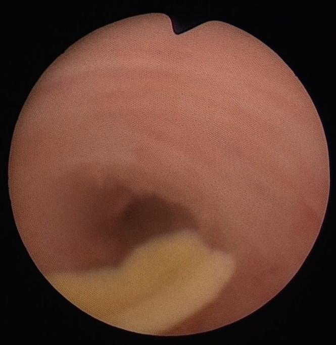 胆管や膵管を閉塞させる原因となる胆管内のタンパク栓（2）