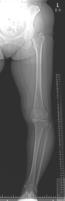 骨切り術前のレントゲン写真