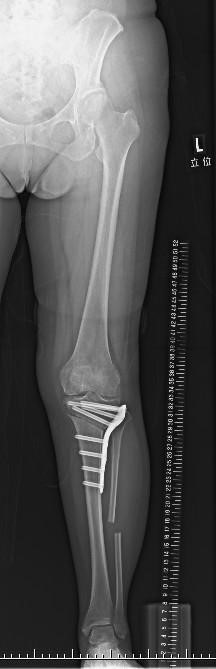 骨切り術後のレントゲン写真