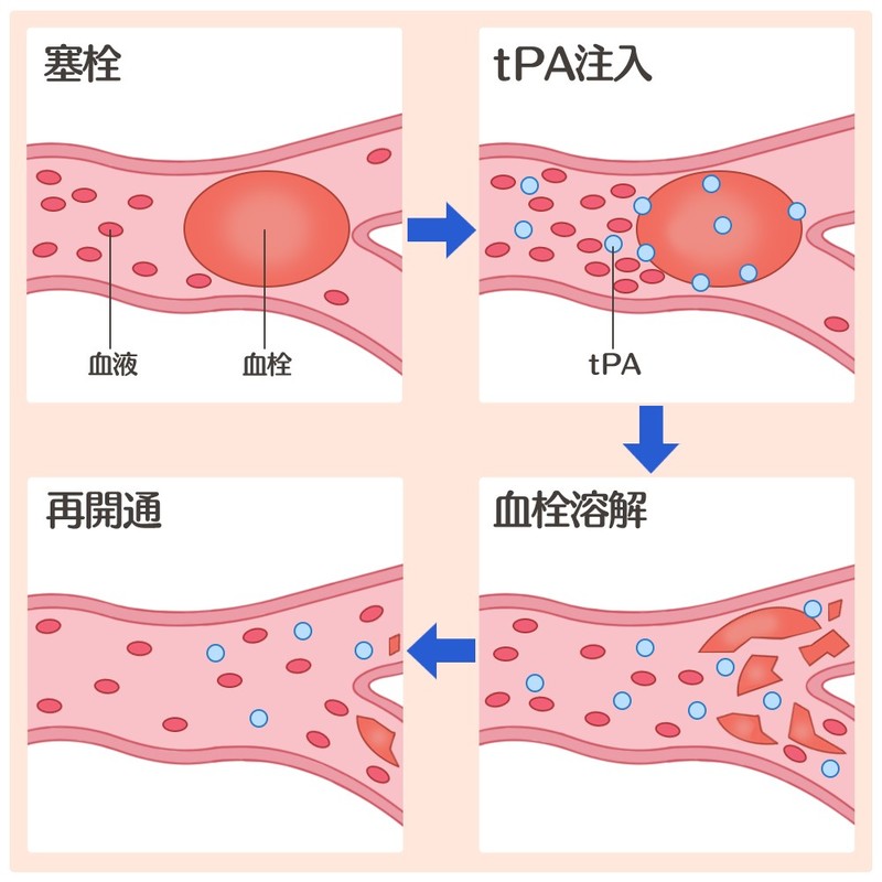t-PA静注療法