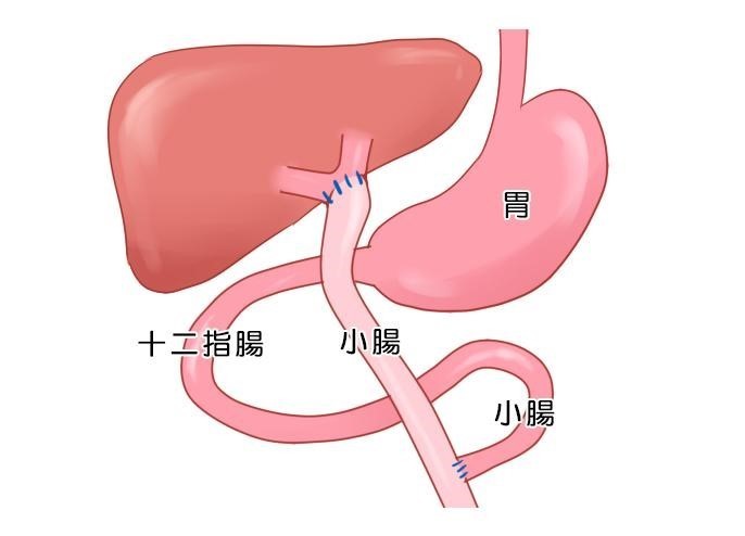 肝管空腸吻合術