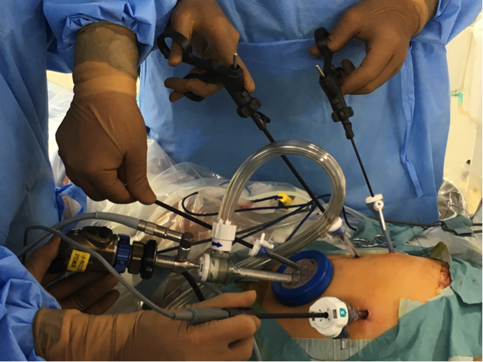 実際の腹腔鏡手術の様子