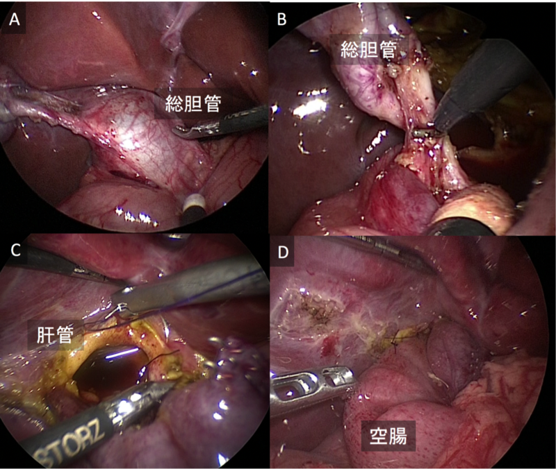 図A：拡張した総胆管、B：膵内胆管の剥離、C：肝管空腸吻合、D：肝管空腸吻合終了