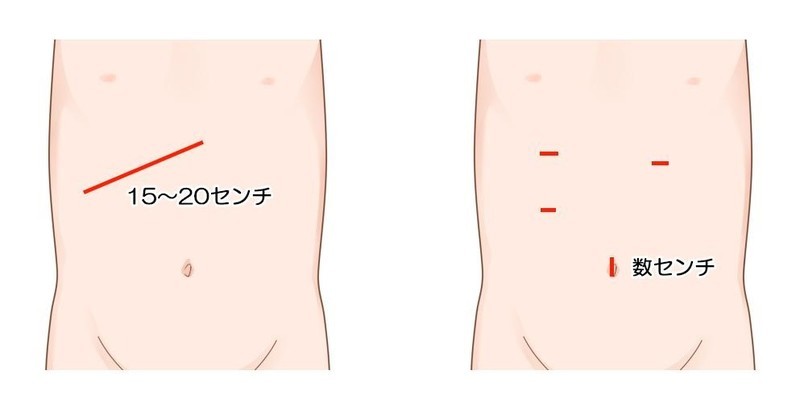 開腹手術（図左）と腹腔鏡手術（図右）の術創イメージ