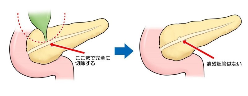 膵内結石、膵炎、膵内遺残胆管がん