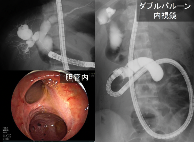 ダブルバルーン内視鏡を用いた胆管空腸吻合部、肝内胆管の観察