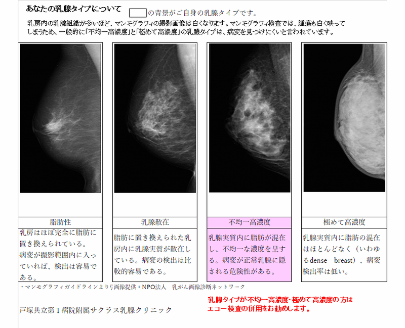 マンモグラフィ検査