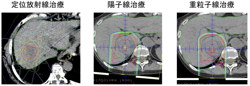 定位放射線治療、陽子線治療、重粒子線治療の放射線の当たり方
