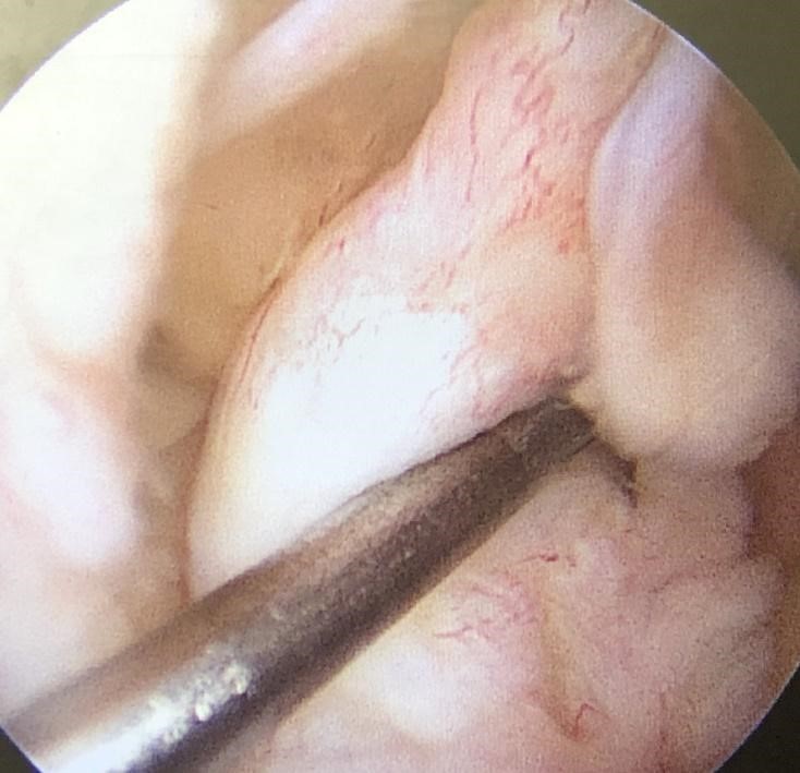 関節鏡が映し出す関節内の映像