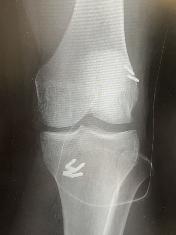 術後XP（先方提供）