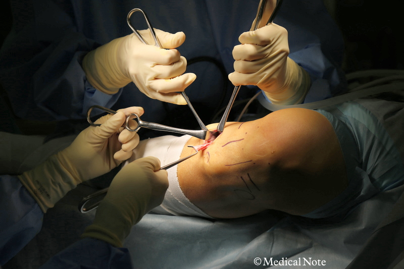 移植腱を採取している様子