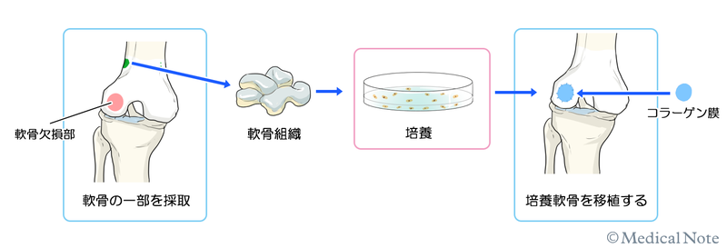 自家培養軟骨移植術の流れ