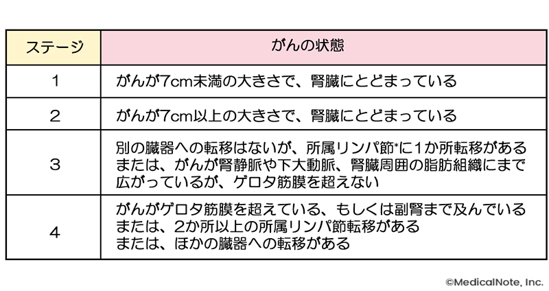 腎細胞がんのステージ（病期）について