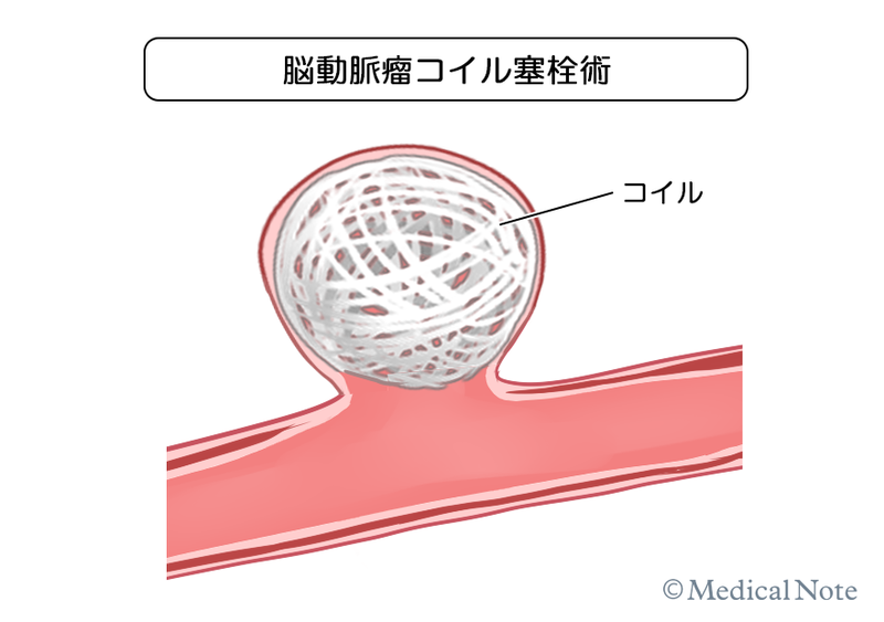 脳動脈瘤コイル塞栓術