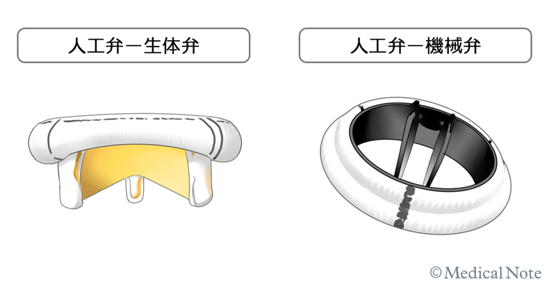 ●僧帽弁置換術における“生体弁”と“機械弁”の使い分け