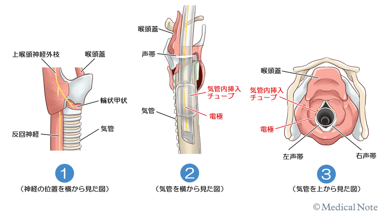神経モニタリングシステム
