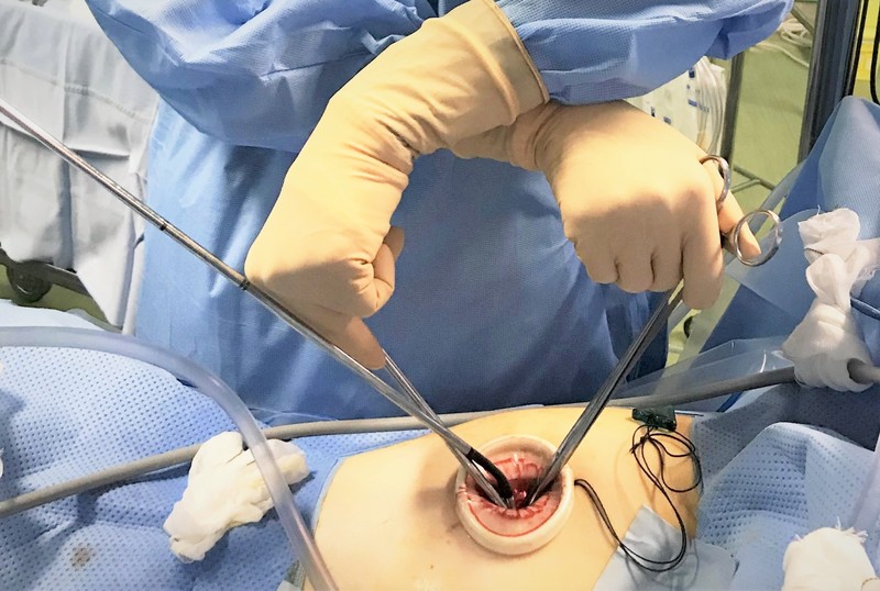 Single port VATS(単孔式胸腔鏡手術)の様子