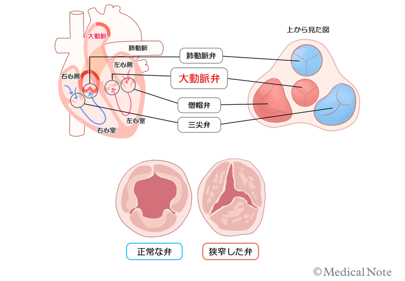 息切れや胸痛、失神など、何かしら症状があれば治療を検討する