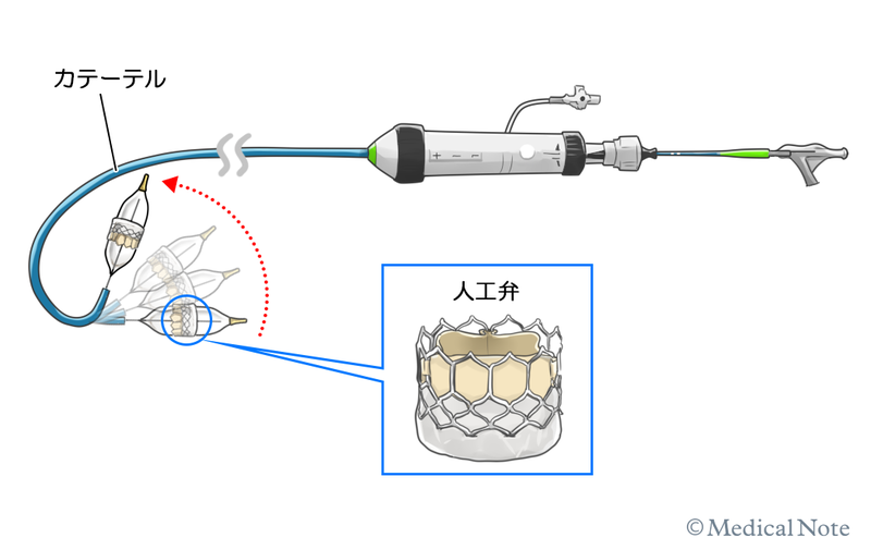 開胸手術