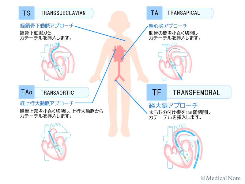 TAVI