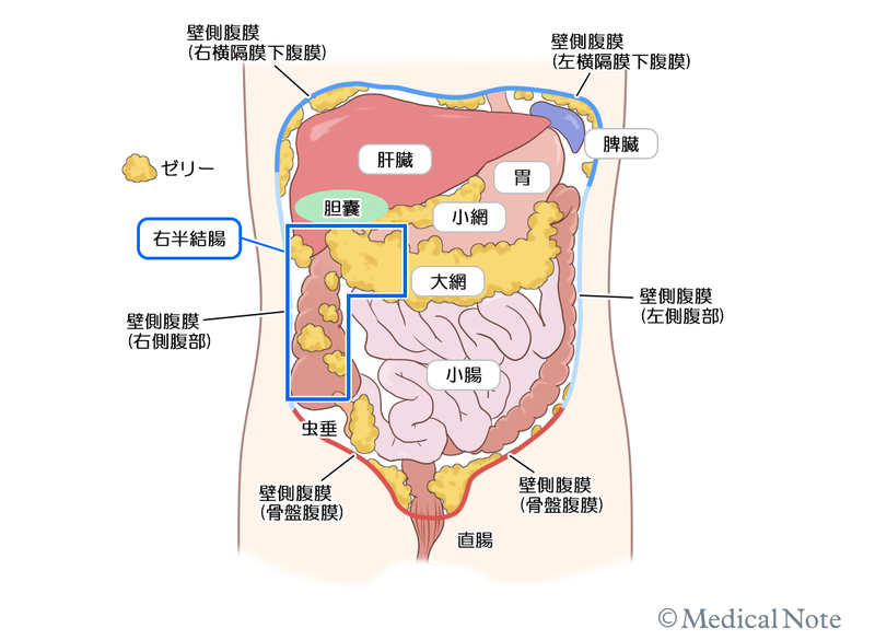 多臓器やリンパ節に転移することはない