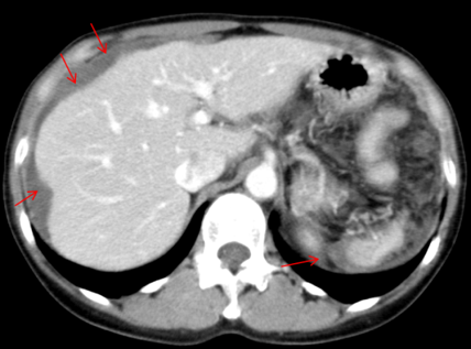 ホタテ貝状変形の様子