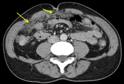 ケーキ様大網の様子