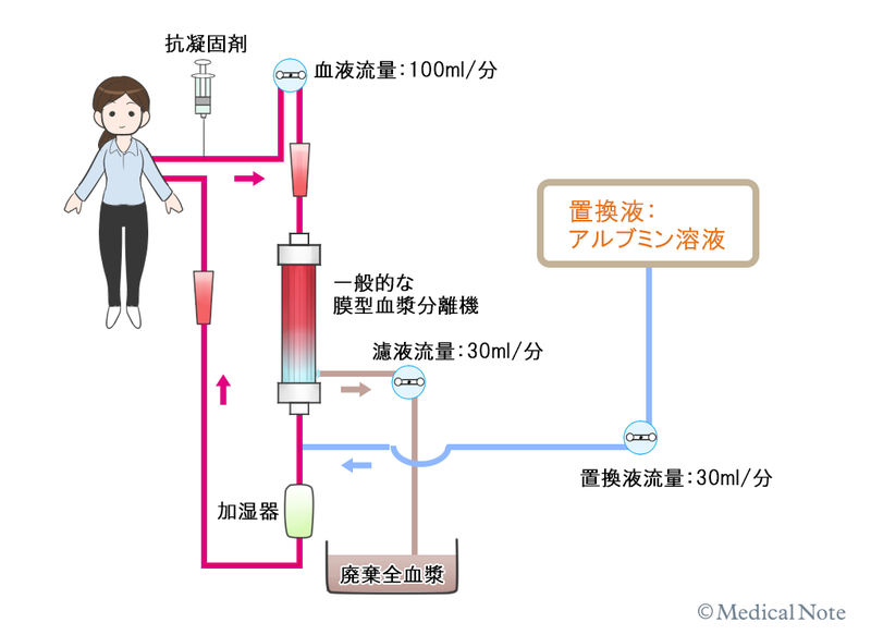 単純血漿交換療法の方法