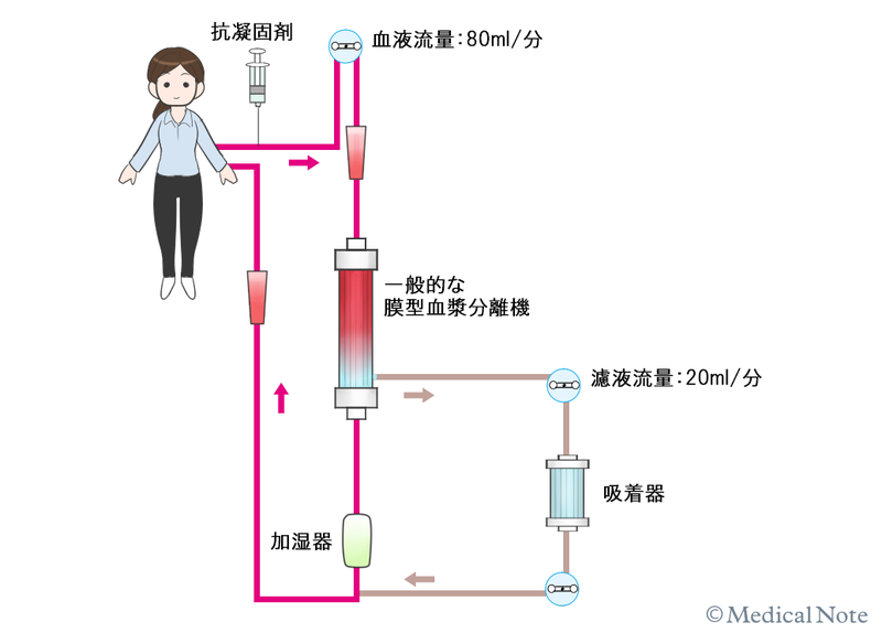 免疫吸着療法の方法