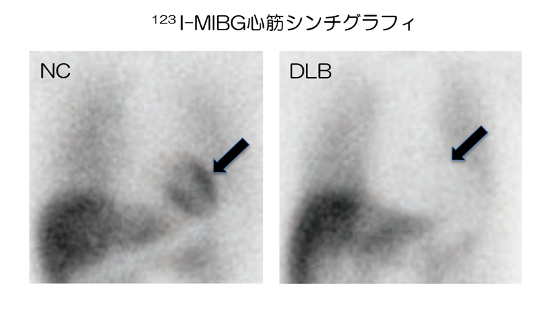 レビー小体型認知症（DLB）の患者さん（右）では健常者（NC）（左）と比べて心臓交感神経終末へのMIBGの取り込み低下が見られる（矢印）