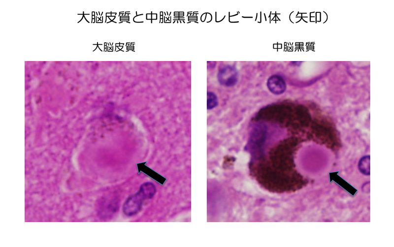 レビー小体型認知症とはどんな病気？ 発症のしくみから治療まで