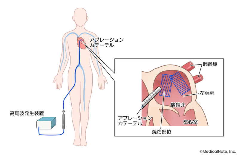 カテーテルアブレーション治療