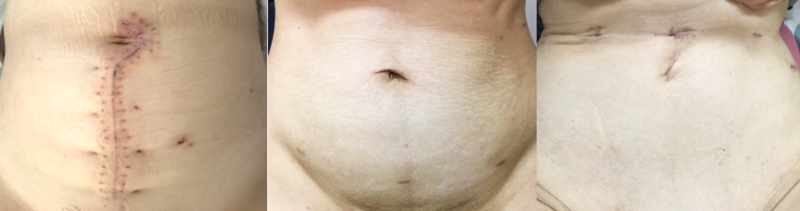 広汎子宮全摘術（こうはんしきゅうぜんてきじゅつ）を行ったときの創部の違い