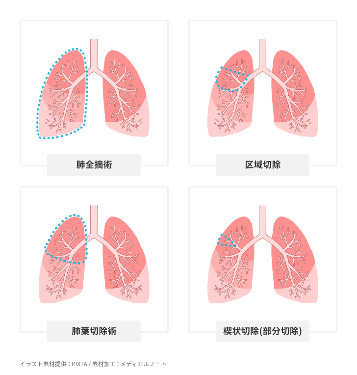 肺がんの手術の方法一覧