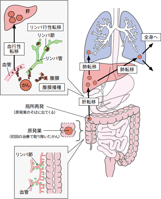 再発・転移の例（大腸がん）