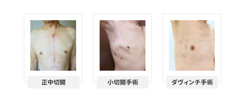 正中切開、小切開手術、ダヴィンチ手術