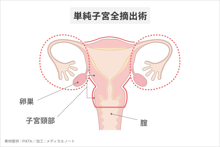 単純子宮全摘出術