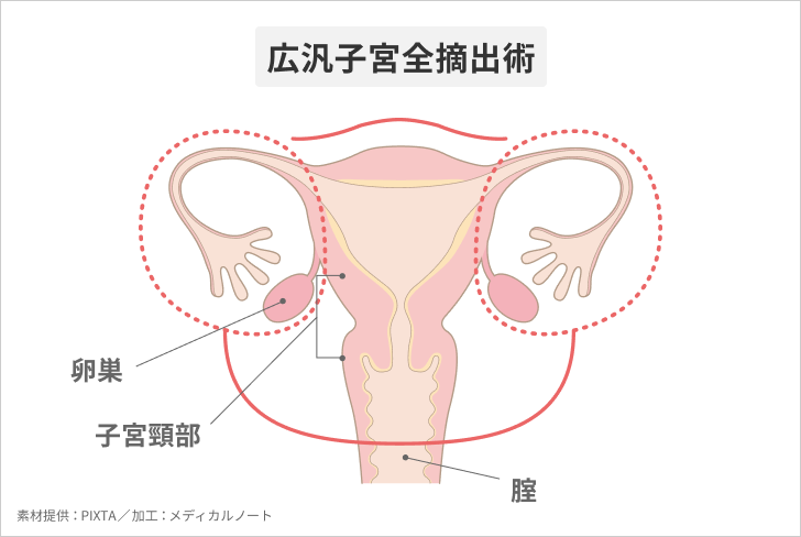広汎子宮全摘出術