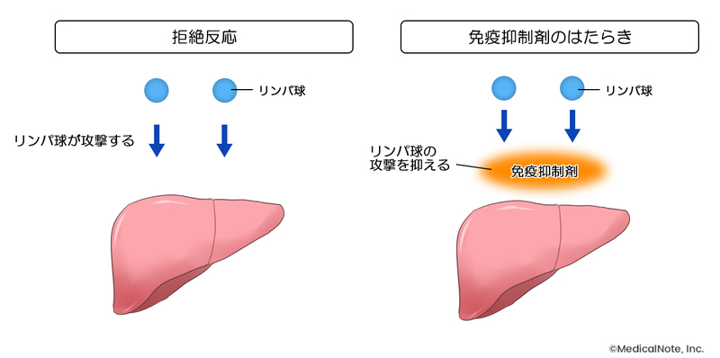 免疫抑制剤のはたらき
