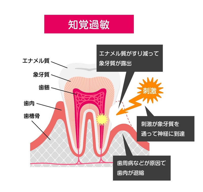 歯磨きや冷たいもので歯がしみるのはなぜ 知覚過敏 象牙質知覚過敏症 の原因や予防法とは メディカルノート