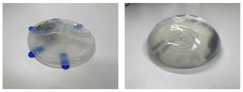 左：エキスパンダー、右：シリコンインプラント