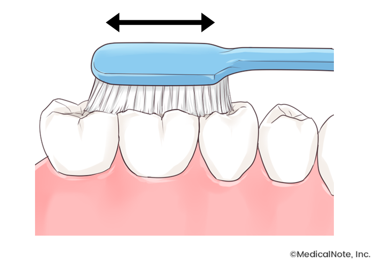 歯周病予防のブラッシング