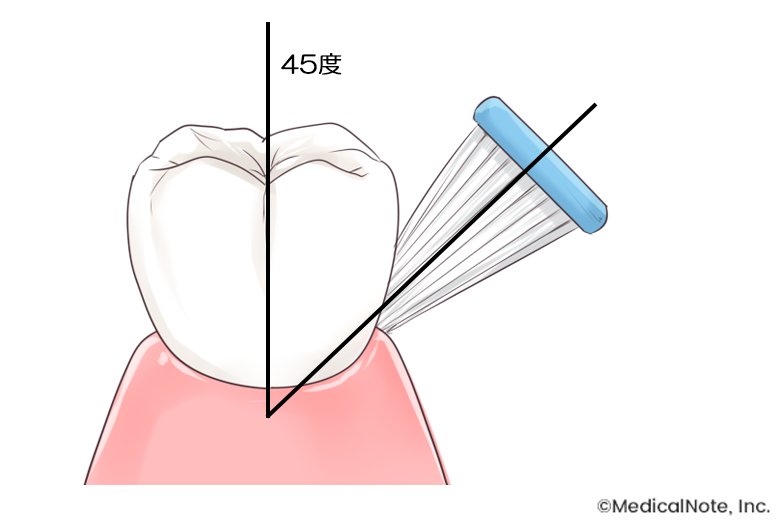 歯周病予防のブラッシング