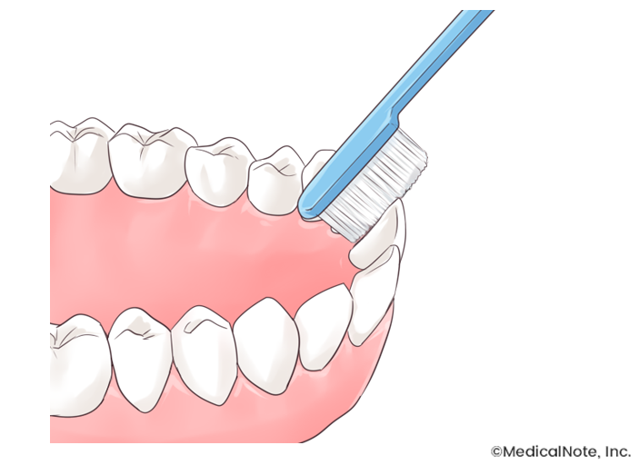 歯周病予防のブラッシング２