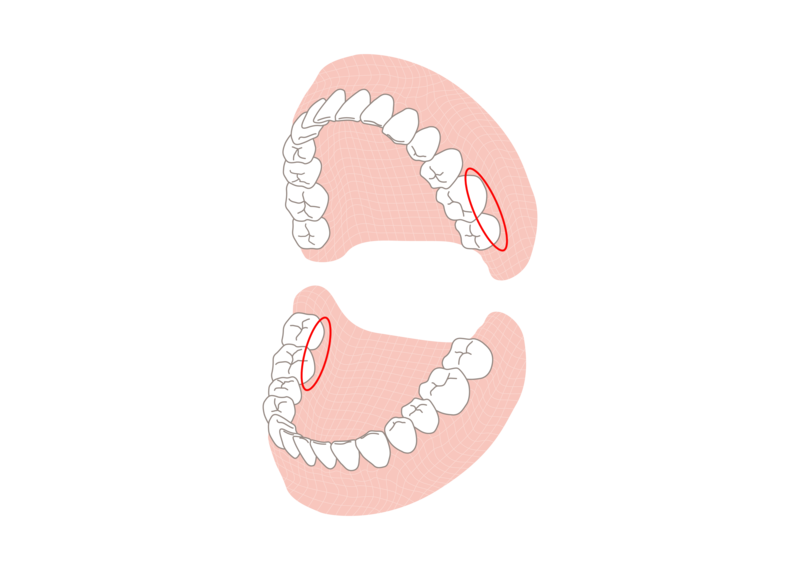 上の奥歯の外側と下の奥歯の内側も要注意ポイント  素材提供：PIXTA／加工：メディカルノート