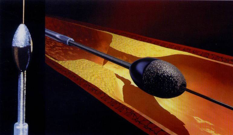 ロータブレーターのイメージ